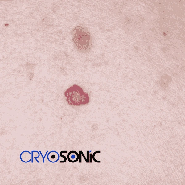 Looking for pain free cherry angioma removal treatment Cobham? Call our team today! Cobham