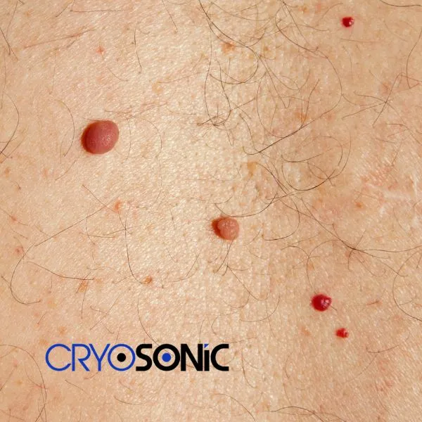 get cherry angioma removal treatment today! Cobham