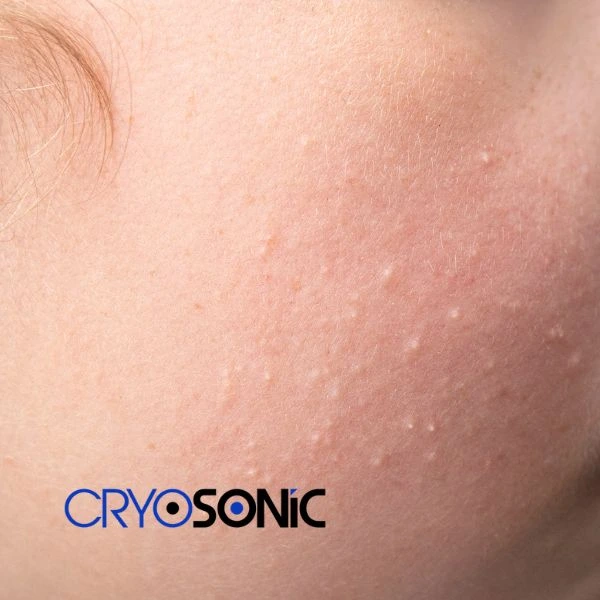 Are you looking for milia removal treatment? Contact our team today Cobham