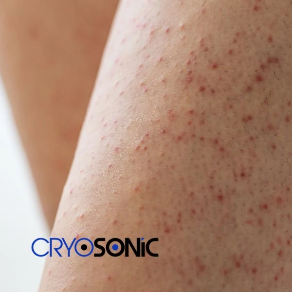 Looking for Seborrhoeic Keratosis removal Cobham treatment? Call our consultants today in Cobham