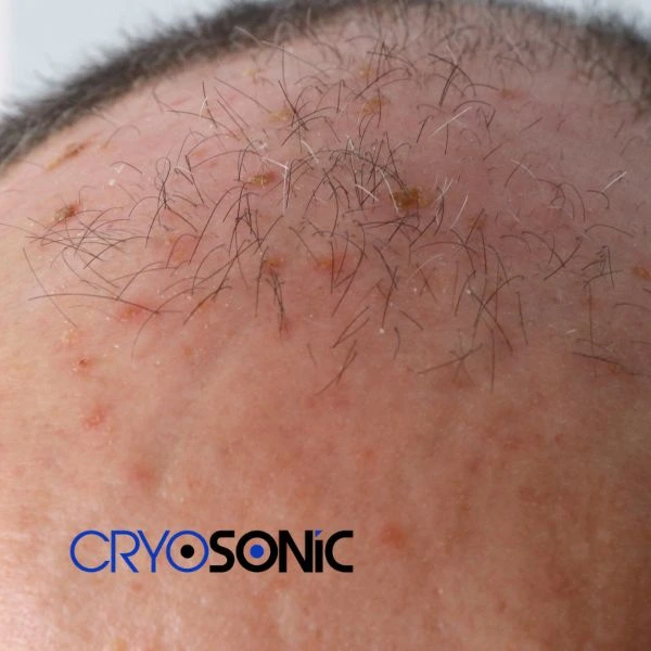Access Seborrhoeic Keratosis removal from the comfort of your own home! Call us today in Cobham