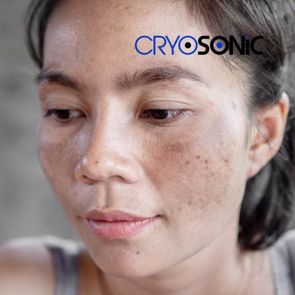 Ready to start age spots removal? Contact our team today in Cobham