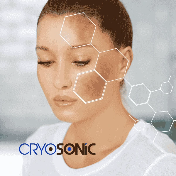 Are you looking for age spot removal treatment? Contact Cryosonic today in Cobham