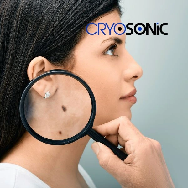 Do you want to learn more about benign moles removal treatment? Call our team today Cobham