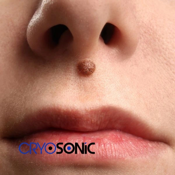Start your benign moles removal treatment today Cobham