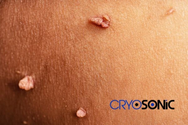 What Can You Expect During and After Your Cryosonic Treatment Cobham