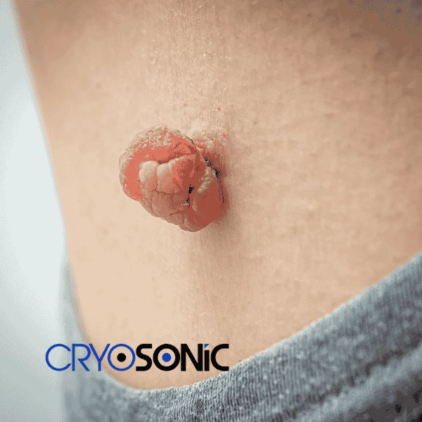 Book your skin tags removal Cobham from comfort of your own home! Cobham
