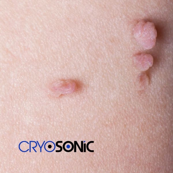 Are you looking for fast effect skin tag removal Cobham? Book in NOW! Cobham
