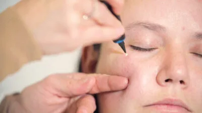 CryoPen device treating milia Cobham cysts on the skin safely and precisely Cobham
