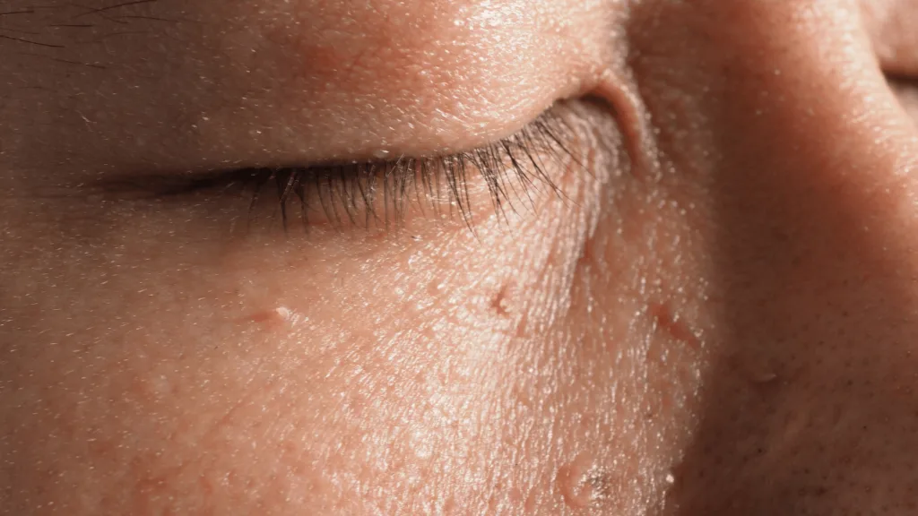 CryoPen removing Skin Tags Cobham with precision, showing safe and controlled ablation for smooth, clear skin by Cryosonic Cobham