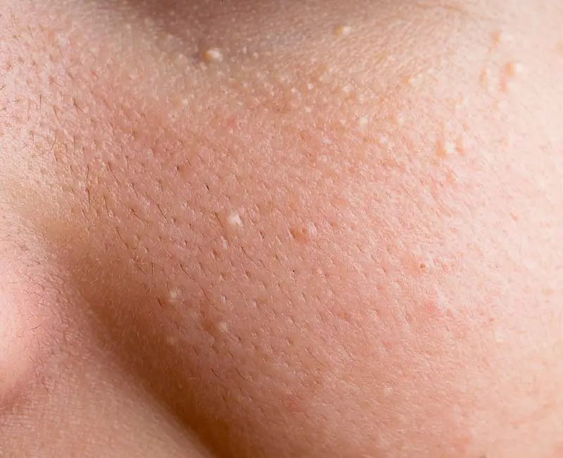 Milia keratin-filled cysts treated with CryoPen for safe scar-free removal Cobham