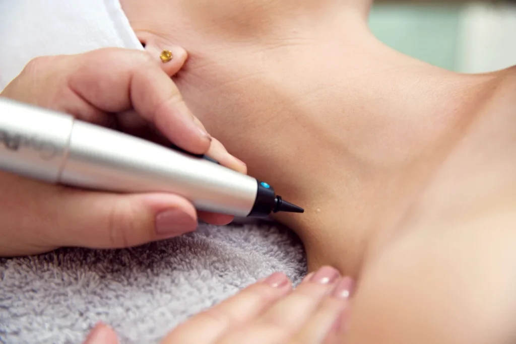CryoPen precisely treating Molluscum Contagiosum lesions, showing safe and effective removal for faster healing by Cryosonic Cobham
