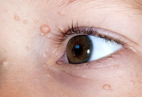 CryoPen treating persistent Molluscum Contagiosum Cobham lesions Cobham