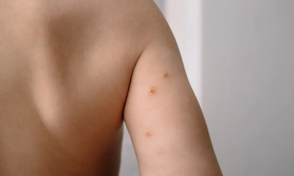 CryoPen treating Molluscum Contagiosum Cobham professionally, highlighting safe and precise lesion removal for improved skin and confidence Cobham