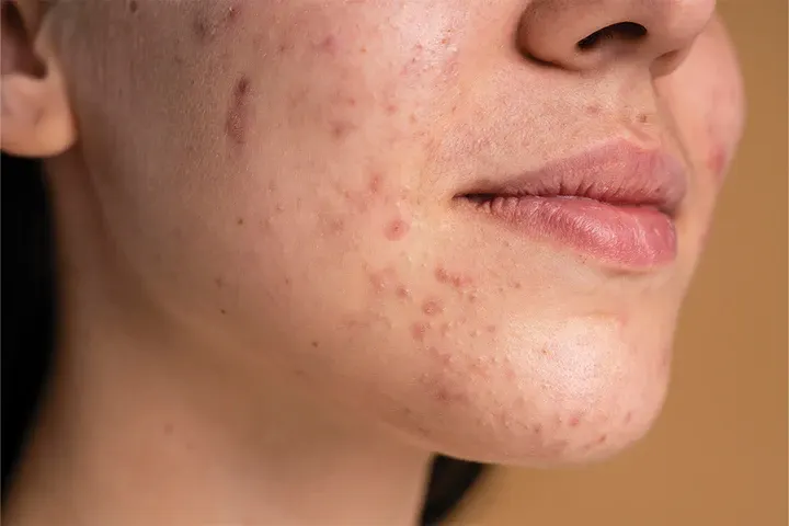 CryoPen precisely removing Skin Tags (fibroepithelial polyps), showing safe and effective treatment for smoother, clearer skin Cobham