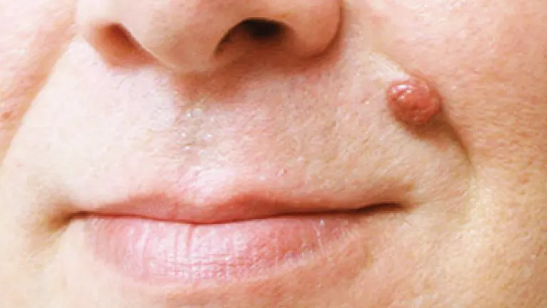 CryoPen safely removing Skin Tags Cobham, showing minimal recurrence risk and precise treatment for smoother, clear skin by Cryosonic Cobham