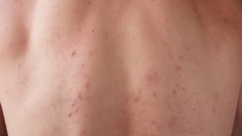 CryoPen treating Cobham Molluscum Contagiosum lesions safely and precisely, illustrating answers to common patient FAQs Cobham
