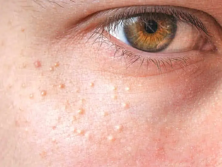 Close-up of skin showing milia Cobham, small keratin-filled cysts on the face Cobham