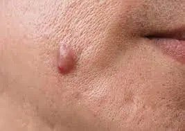 common causes of Skin Tags Cobham formation, including friction, genetics, and hormonal changes Cobham